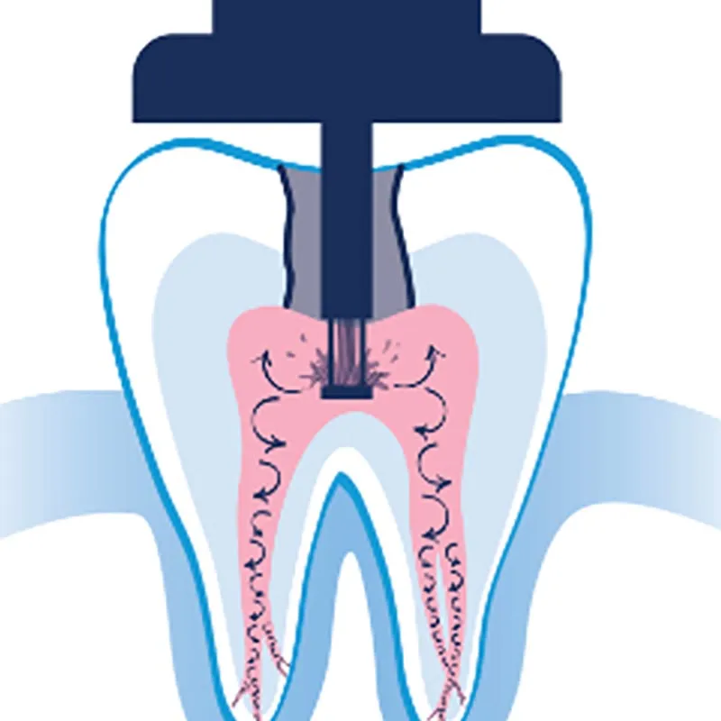 gentle wave procedure - Fox Creek Endodontics